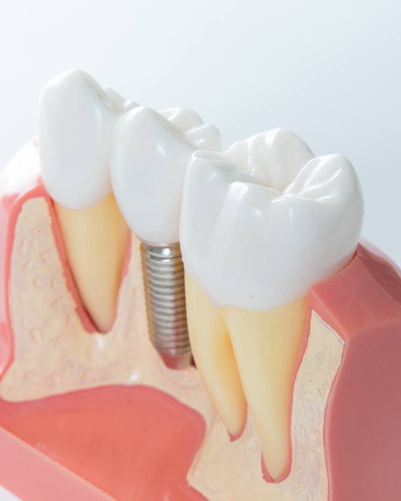 Imagen Implantología Straumann
